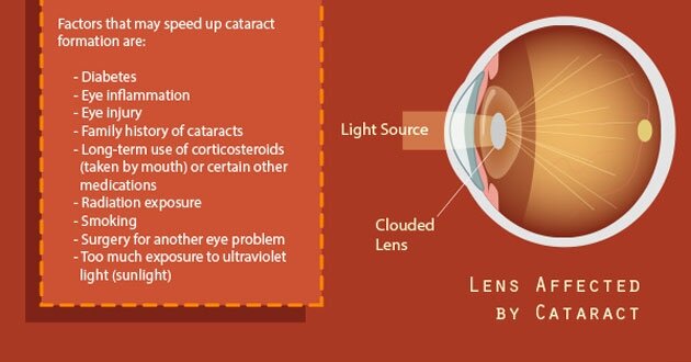 Cataract Awareness Infographic F