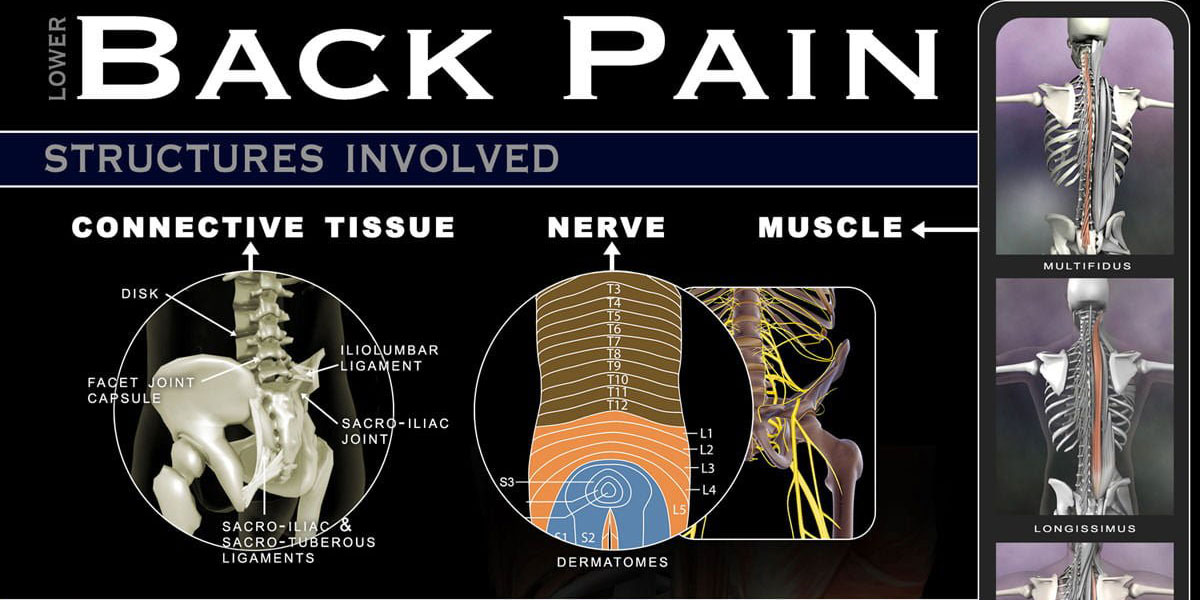 Lower Back Pain Infographic F