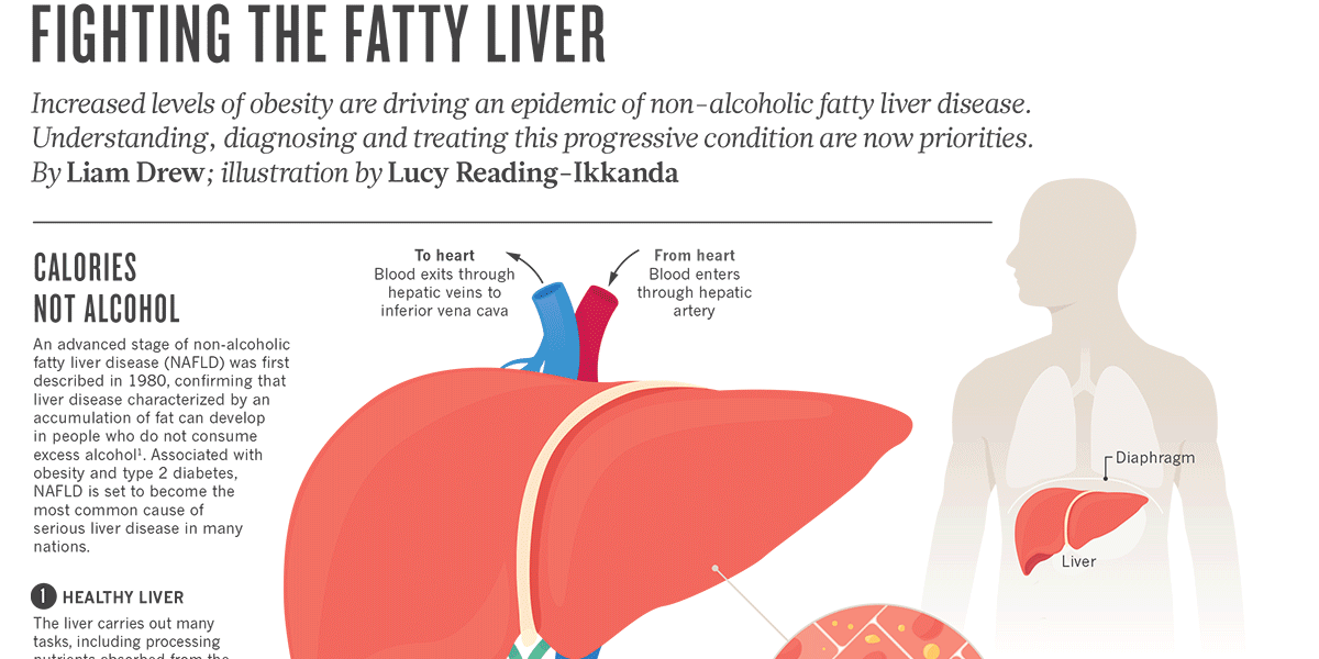 Nonalcoholic Fatty Liver Disease F