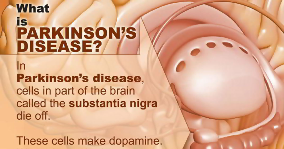 Parkinsons Disease Infographic F