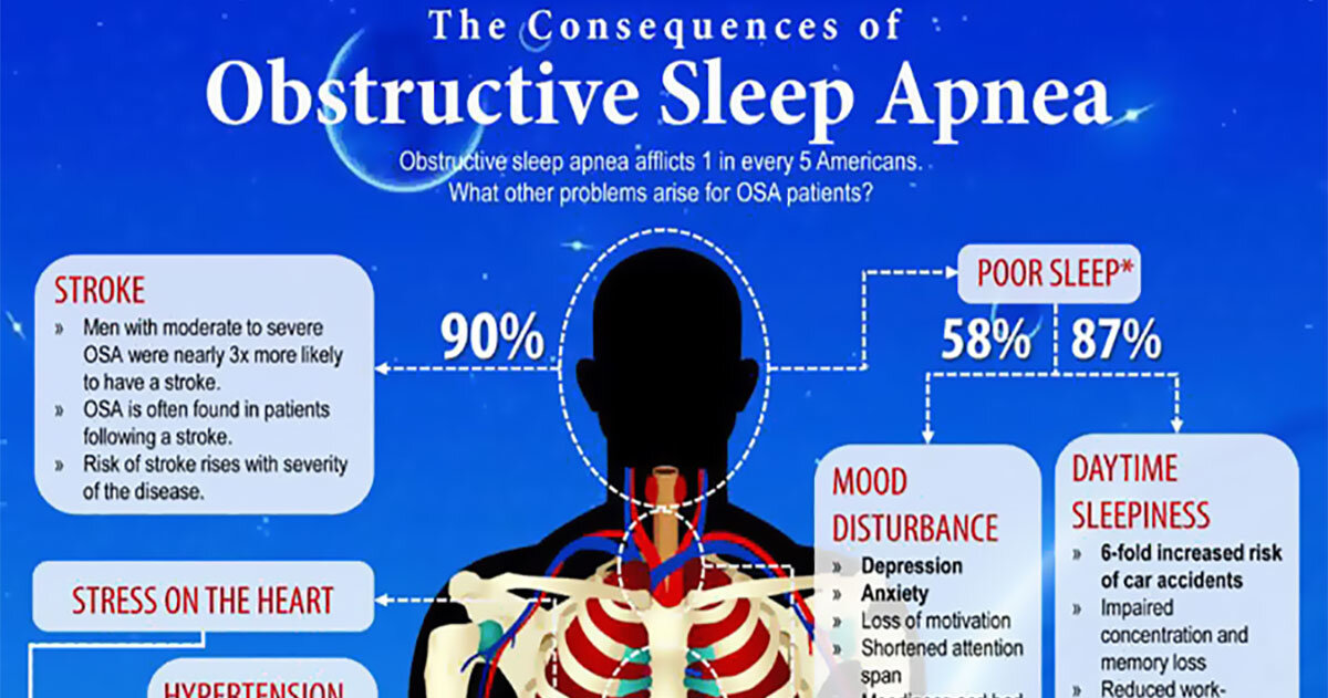 Sleep Apnea Linked To Increased Risk Of Silent Stroke Symptoms