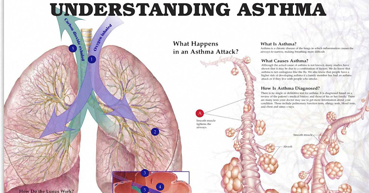 Understanding Asthma Chart F