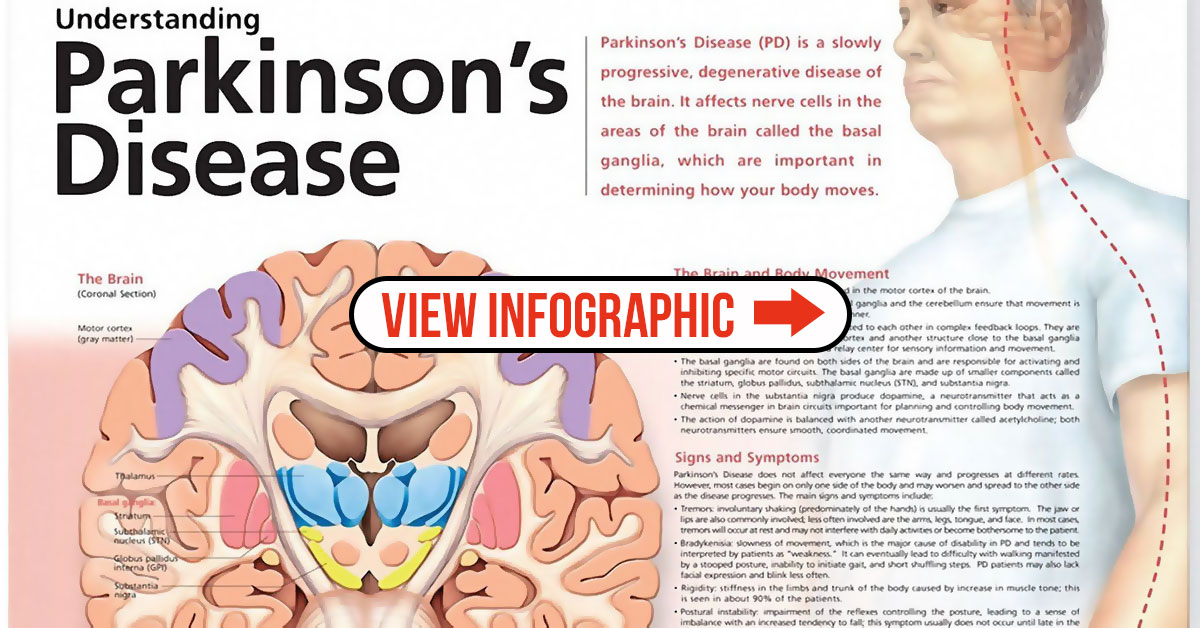 Understanding Parkinson S Disease Poster Parkinsons Anatomical Chart Vrogue