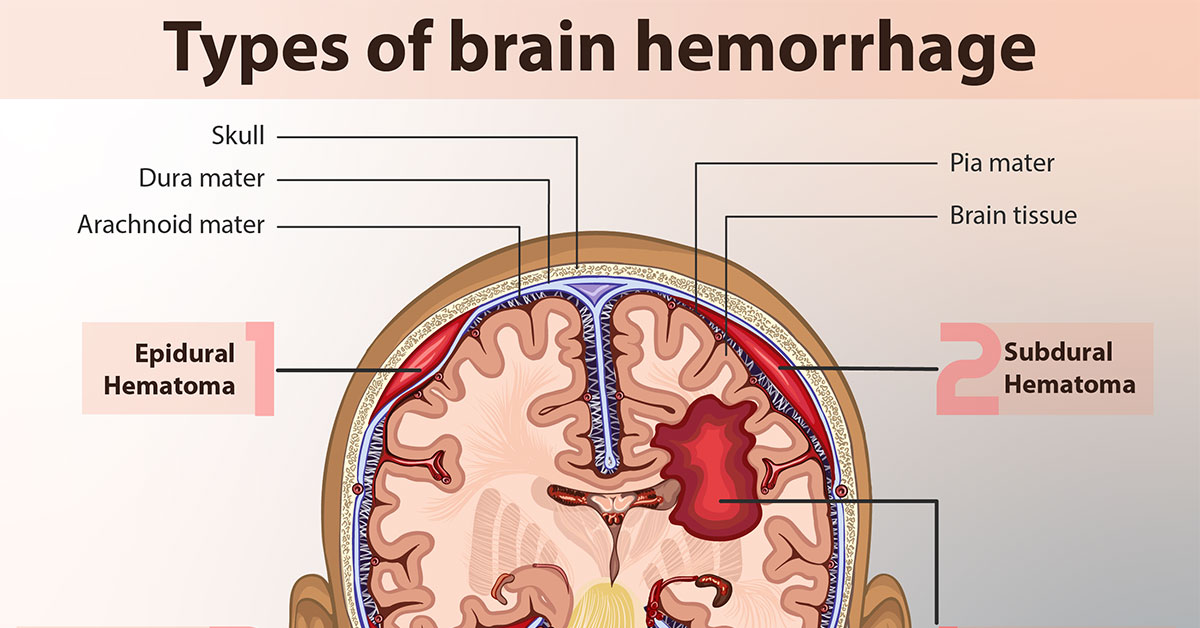 Different Types Of Brain Hemorrhage F